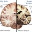 image of heathy cum unhealthy brain