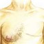 breast cancer in men