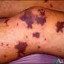 meningococcemia image
