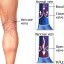 varicose-veins-picture