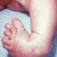 clubfoot_baby