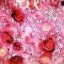 image of pneumococcal