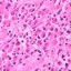 image of typhoid
