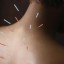 image of acupuncture