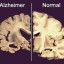 image of normal and with alzheimer