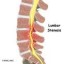 image of stenosis
