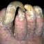 image of fungal infection