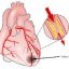 image of heart disease