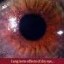 dry eye image