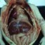 image of neonatal sepsis