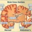 image of alzheimer's