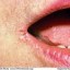 image of cracked lips