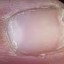 image of brittle nail
