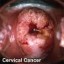 image of cervical cancer