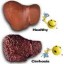 image of cirrhosis & normal liver