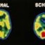schizophrenia