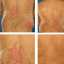 Psoriasis