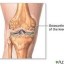 image of osteoarthritis