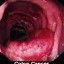 colorectal cancer