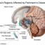 parkinson's image