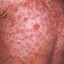 image of measles