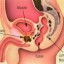 image of prostate cancer