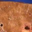 cirrhosis of the liver