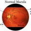 image of age related macular degeneration