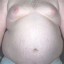 image of metabolic syndrome