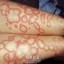 lupus systemic
