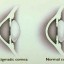 astigmatism image