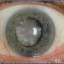 image of eye with cataract