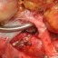 image of kidney transplantation