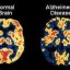 image of alzheimer's