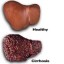 liver with cirrhosis needs a liver transplant