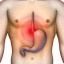 acid reflux