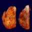 cell tumor