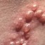 chickenpox virus image