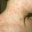 image of aquagenic urticaria