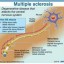 image of multiple sclerosis