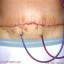 abdominoplasty procedure done in men