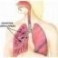 lungs with tuberculosis