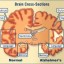 image of brain with alzheimer's