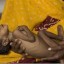 image of malnutrition