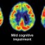 mild cognitive impairment image