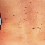 moles