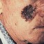 face affected by melanoma