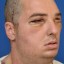 face of patient after transplant