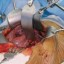liver transplant undertaken to patient