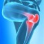 arthritis